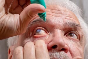 O glaucoma é uma das principais causas de cegueira irreversível em todo o mundo 